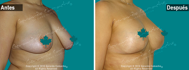 Testimonio mamoplastia de reduccion Gerardo Camacho